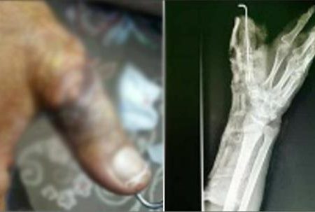 پیوند موفقیت‌آمیز “انگشت قطع شده” در بیمارستان میناب