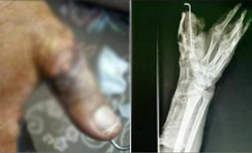پیوند موفقیت‌آمیز “انگشت قطع شده” در بیمارستان میناب